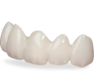 Dental Bridges