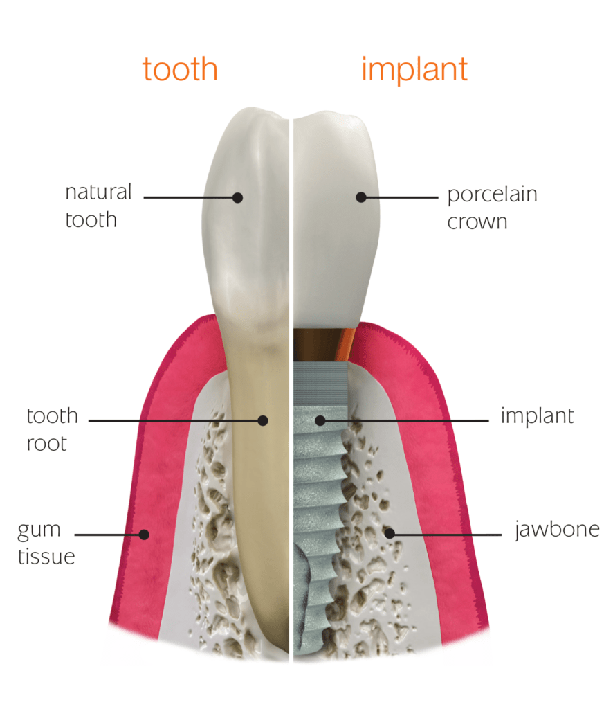 Dental Implants