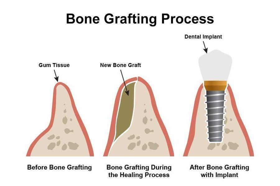 bone grafting coral gables